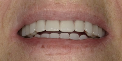 smile-after-54